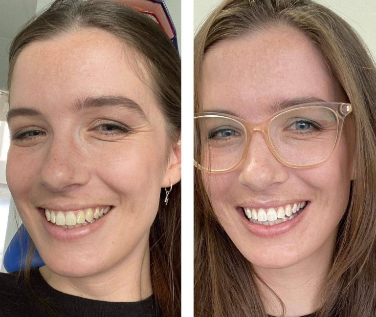 Extra-Strength Whitening Gold Serum Pen Dual-Peroxide Formula